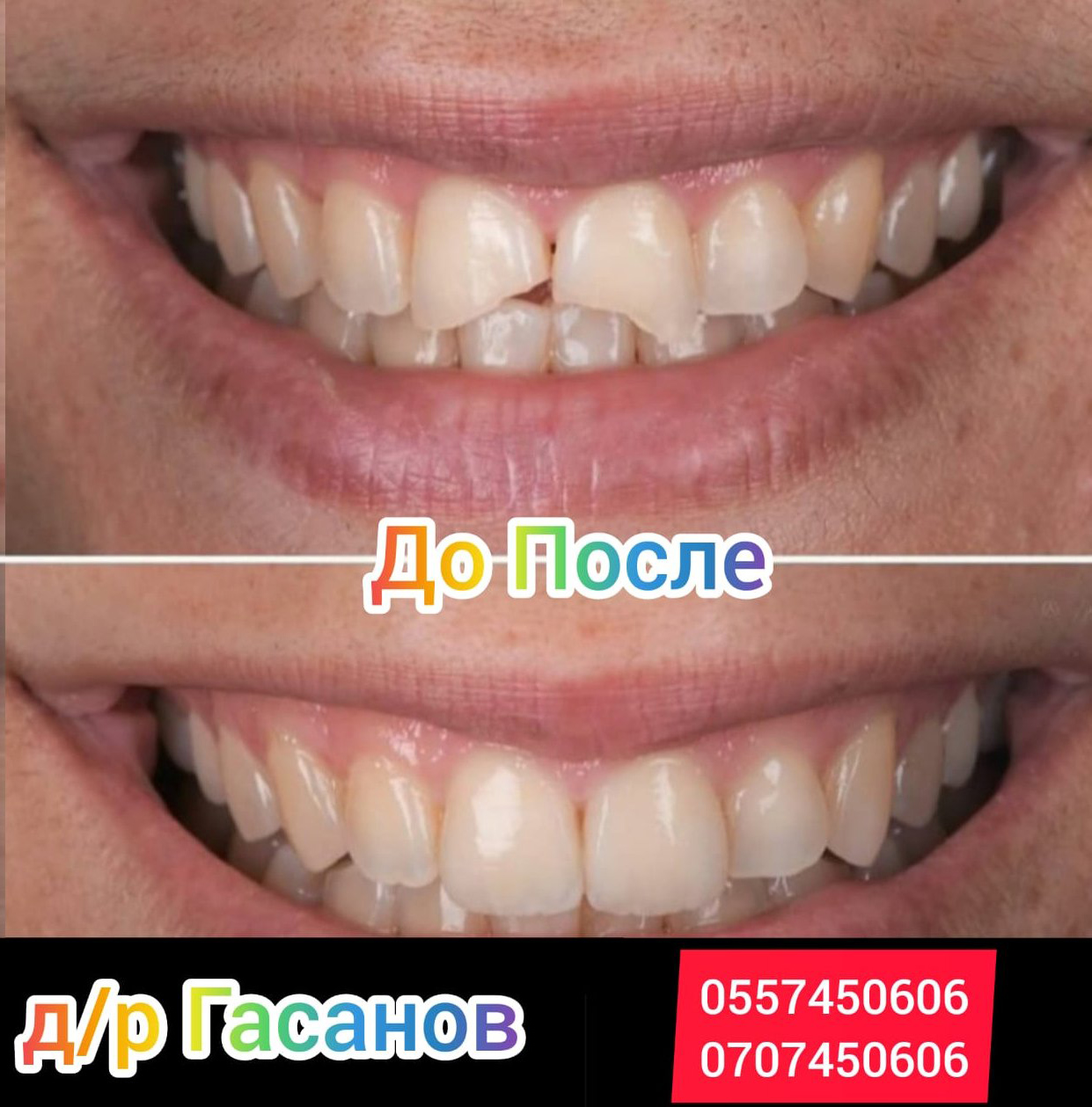 Циркониевые коронки