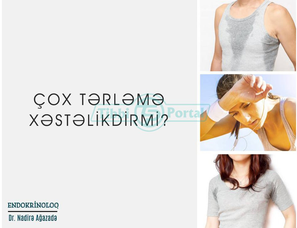 Çox tərləmə xəstəlikdirmi?
