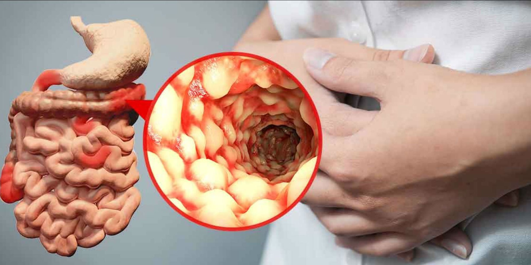 Crohn xəstəliyinin və ulserativ (xoralı) kolitin bioloji müalicəsi