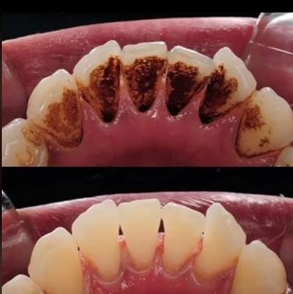 Diş lövhəsinin çıxarılması