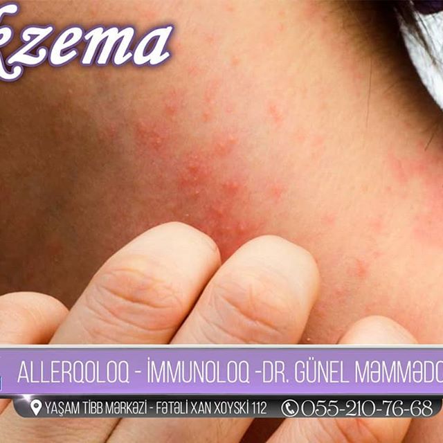 Ekzema
