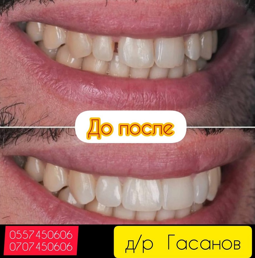 Отбеливание зубов