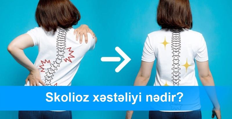 Yeniyetmə və uşaqlarda skolioz​